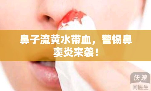 鼻子流黃水帶血，警惕鼻竇炎來襲！