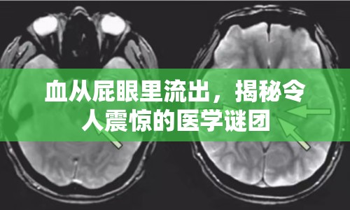 血從屁眼里流出，揭秘令人震驚的醫(yī)學(xué)謎團(tuán)