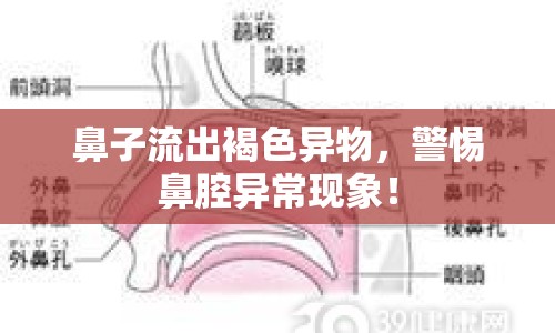 鼻子流出褐色異物，警惕鼻腔異常現(xiàn)象！