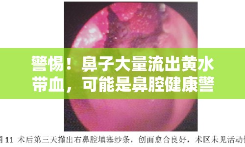 警惕！鼻子大量流出黃水帶血，可能是鼻腔健康警報！