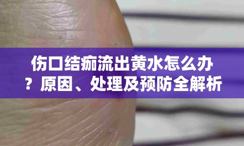 傷口結(jié)痂流出黃水怎么辦？原因、處理及預防全解析