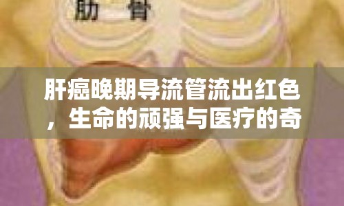 肝癌晚期導流管流出紅色，生命的頑強與醫(yī)療的奇跡