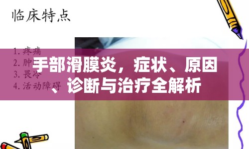 手部滑膜炎，癥狀、原因、診斷與治療全解析