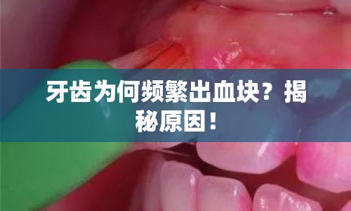 牙齒為何頻繁出血塊？揭秘原因！