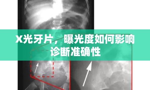 X光牙片，曝光度如何影響診斷準確性
