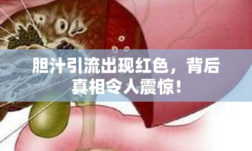 膽汁引流出現(xiàn)紅色，背后真相令人震驚！