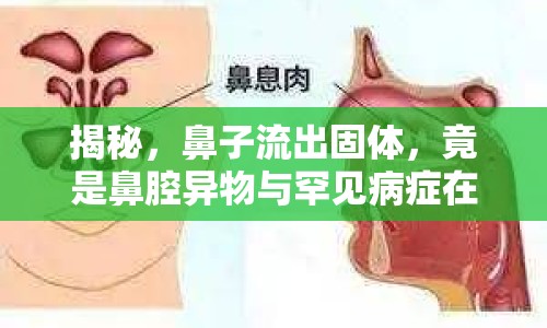 揭秘，鼻子流出固體，竟是鼻腔異物與罕見(jiàn)病癥在作祟！
