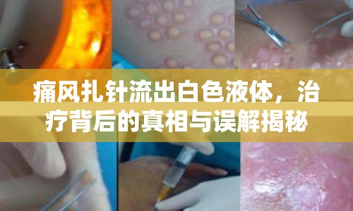 痛風(fēng)扎針流出白色液體，治療背后的真相與誤解揭秘