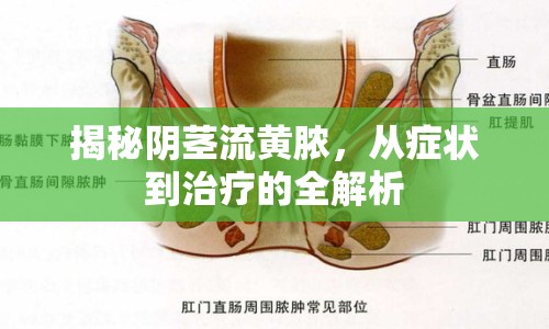 揭秘陰莖流黃膿，從癥狀到治療的全解析
