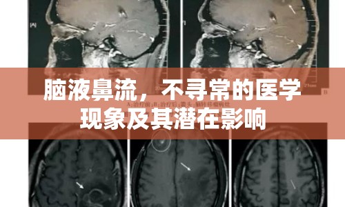 腦液鼻流，不尋常的醫(yī)學現(xiàn)象及其潛在影響