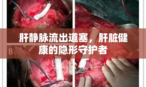 肝靜脈流出道塞，肝臟健康的隱形守護者