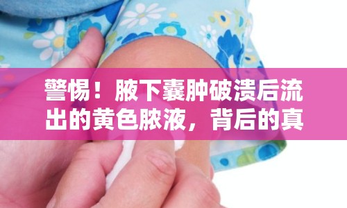 警惕！腋下囊腫破潰后流出的黃色膿液，背后的真相與應(yīng)對措施