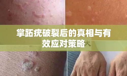 掌跖疣破裂后的真相與有效應(yīng)對(duì)策略