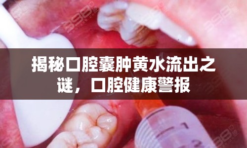 揭秘口腔囊腫黃水流出之謎，口腔健康警報