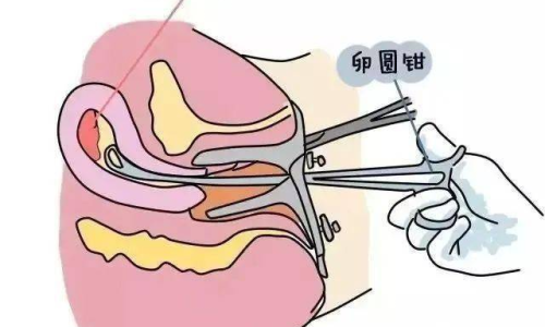 藥流會流出來，全面解析藥物流產(chǎn)的過程與注意事項